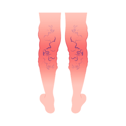 Варикозное расширение вен