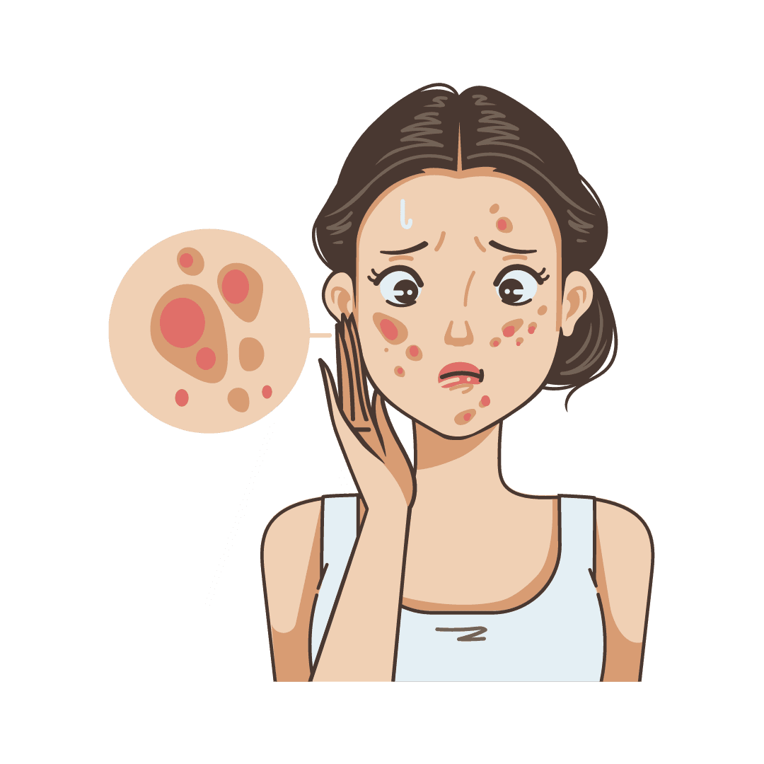 Акне и угревая сыпь