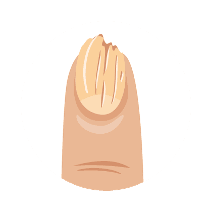 Ломкость ногтей