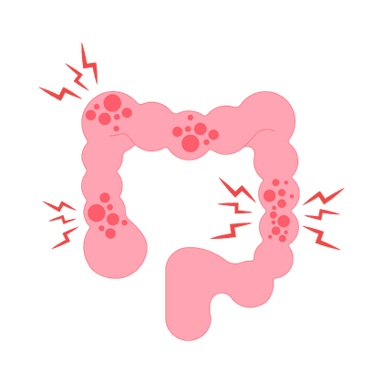 Синдром раздраженного кишечника (СРК)